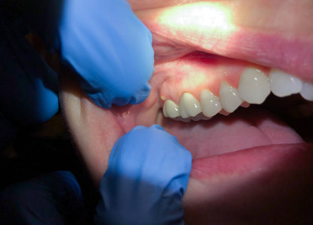 Best Emergency Dental Care for Broken or Chipped Teeth in Kingston, TN